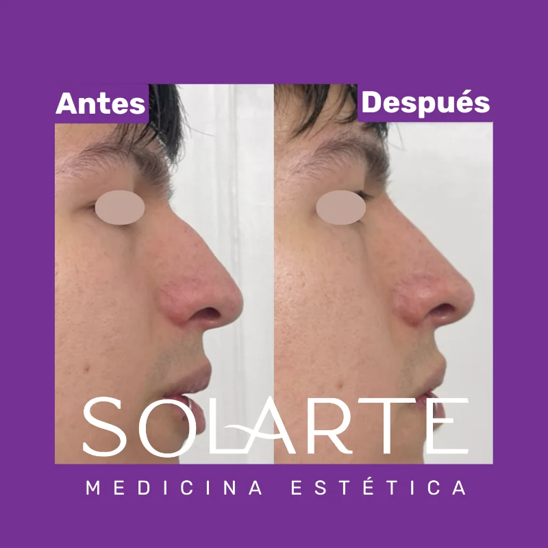 Antes y después de rinomodelación con RinoArte® — perfil masculino