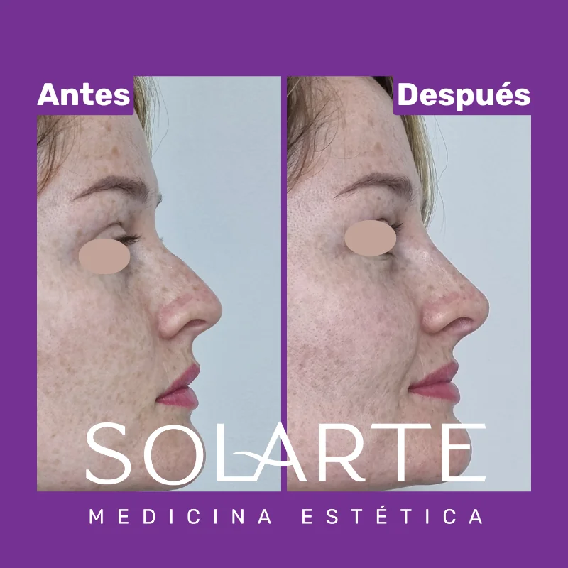 Antes y después de rinomodelación con RinoArte® — perfil femenino