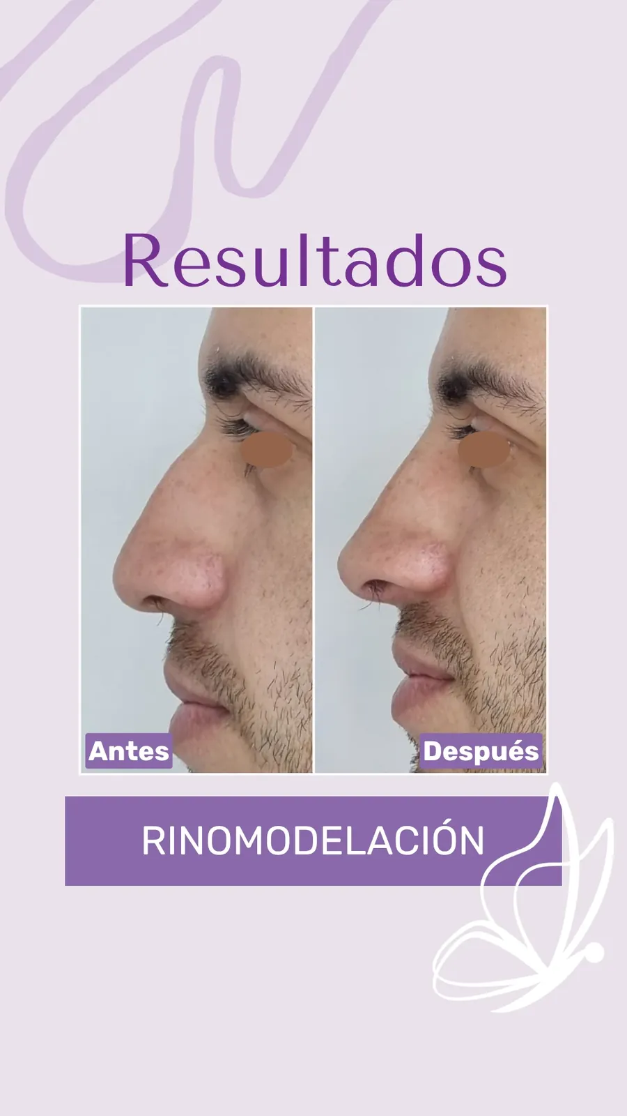 Antes y después de rinomodelación con RinoArte® — perfil masculino