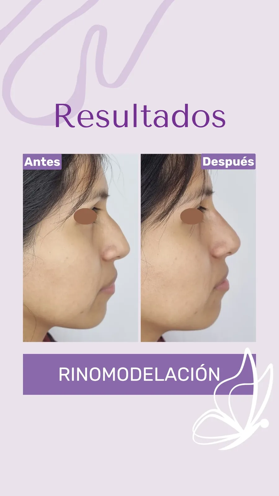 Antes y después de rinomodelación con RinoArte® — perfil femenino